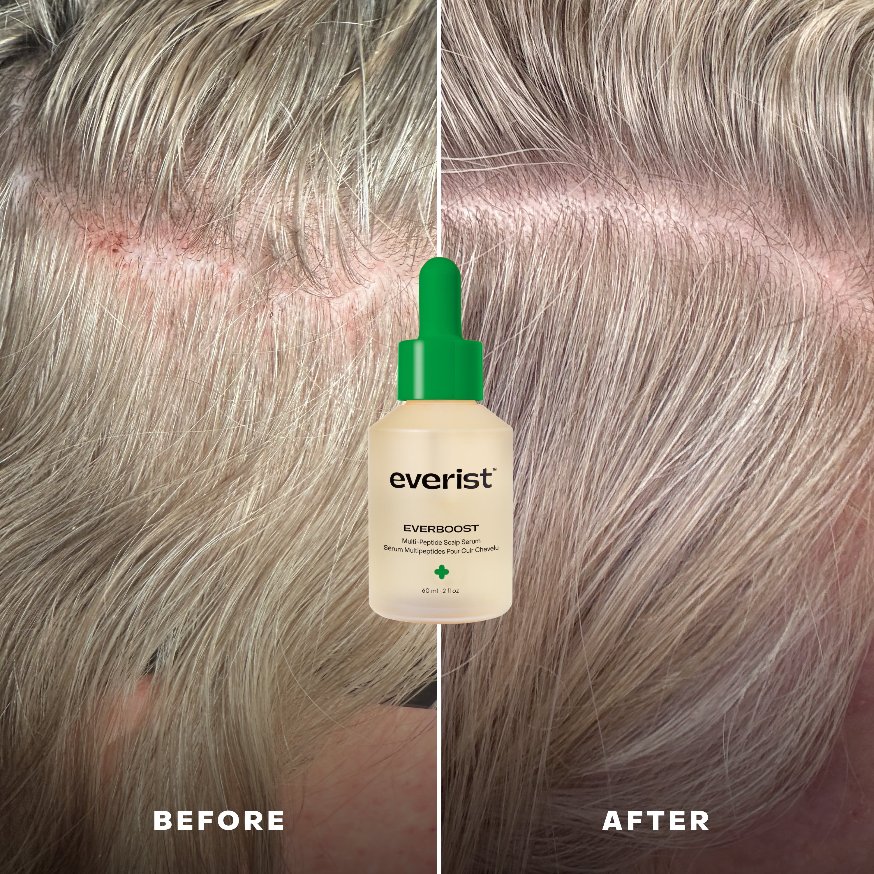 02042026_Everist_Website_BeforeAfter_EverBoost.jpg
