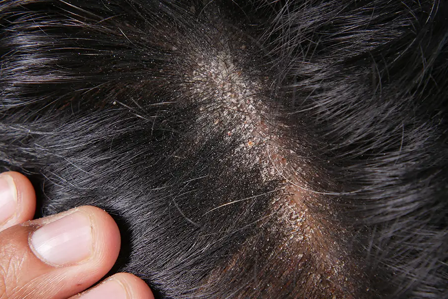 Problem: Your Scalp Feels Tight and Flaky